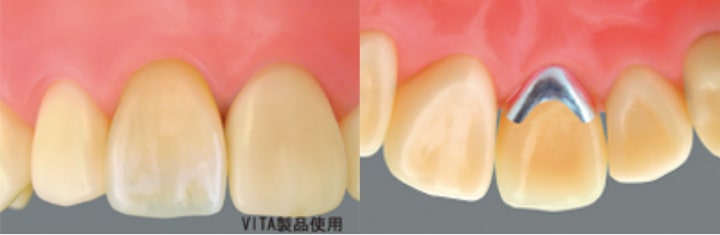 恵比寿の歯医者、かめだ歯科クリニックのメタルボンド（内側が金属）