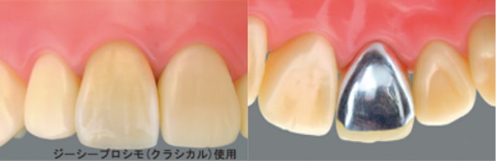 恵比寿の歯医者、かめだ歯科クリニックの硬質レジンクラウン