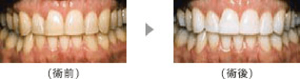 恵比寿の歯医者、かめだ歯科クリニックのホワイトニング