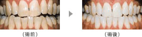 恵比寿の歯医者、かめだ歯科クリニックのホワイトニング